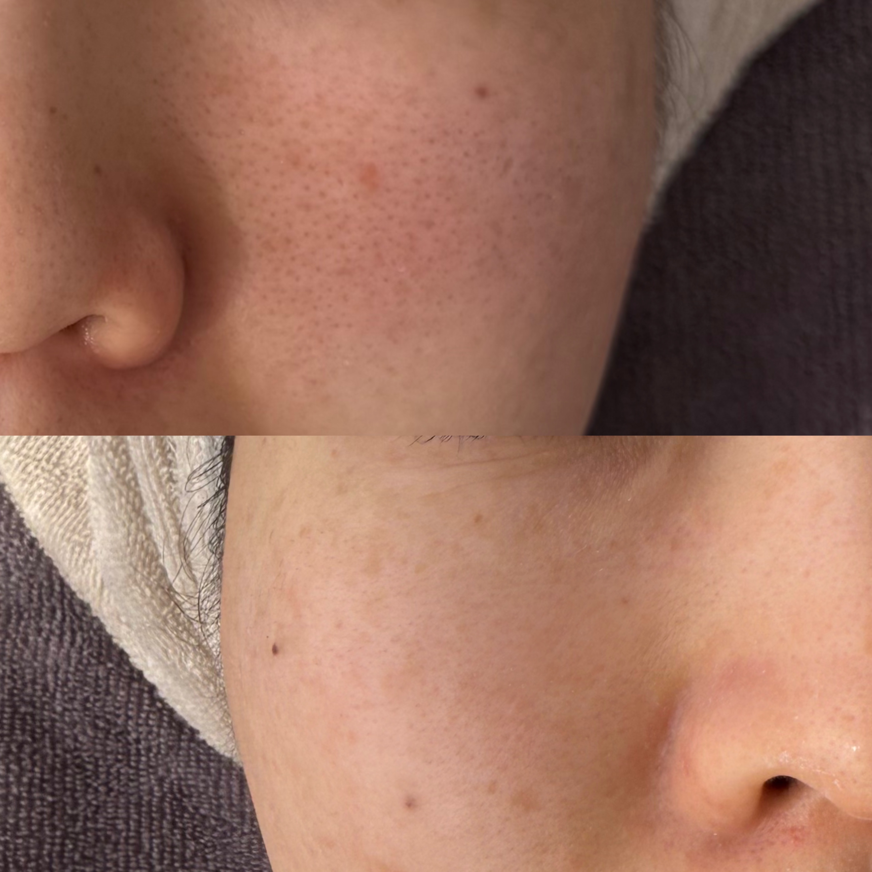 Pores before and after