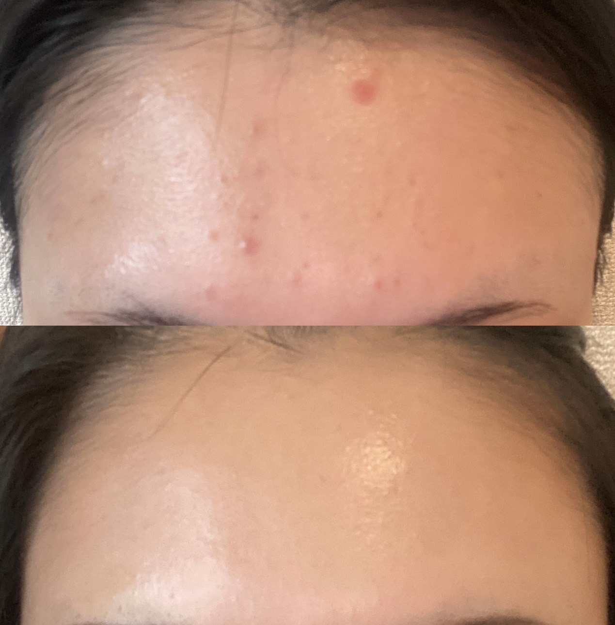 Troubled skin before and after
